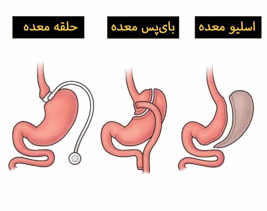 جراحی چاقی