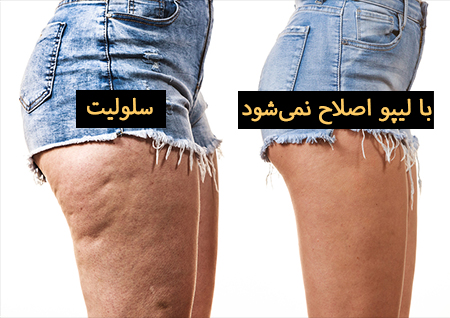 سلولیت