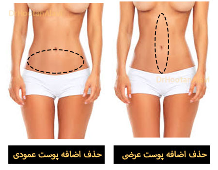 پوست اضافه در جراحی شکم