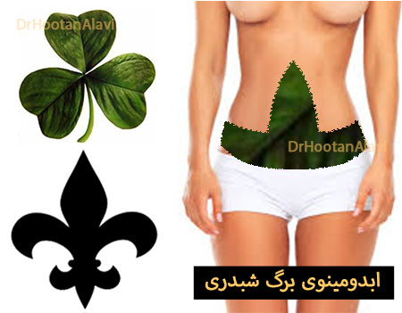 ابدومینوپلاستی برگ شبدری