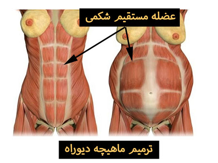 ترمیم عضلات جدار شکم
