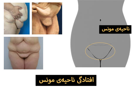 افتادگی مونس
