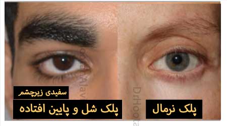 سفیدی زیر چشم