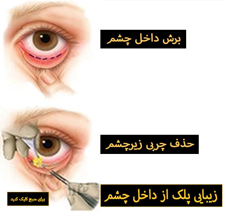 جراحی از طریق ملتحمه