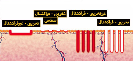 لیزر فراکشنال تخریبی