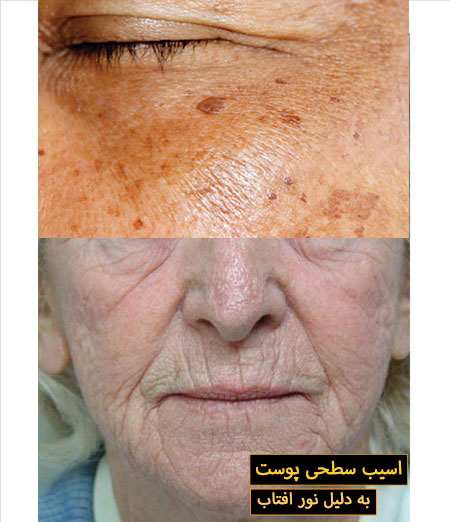 اسیب پوست به دلیل افتاب