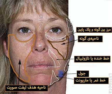 چین‌های ناشی از افتادگی