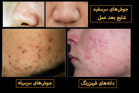 جوش بعد عمل بینی جوش بینی