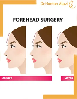 شکل-دهی-به-پیشانی