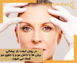 لیفت-باز-پیشانی-چیست