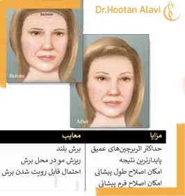 مقایسه-لیفت-باز-پیشانی-با-لیفت-آندوسکوپی