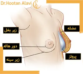 نحوه-برش-پروتز-سینه