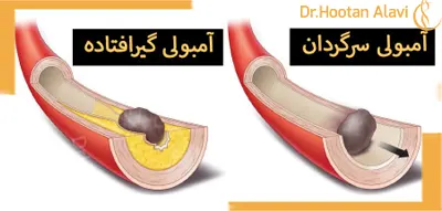 آمبولی-چیست؟