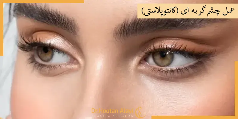عمل-چشم-گربه-ای-کانتوپلاستی