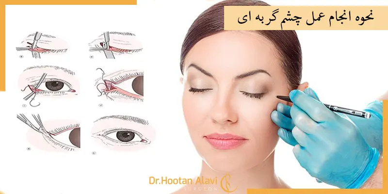 نحوه-انجام-عمل-چشم-گربه-ای