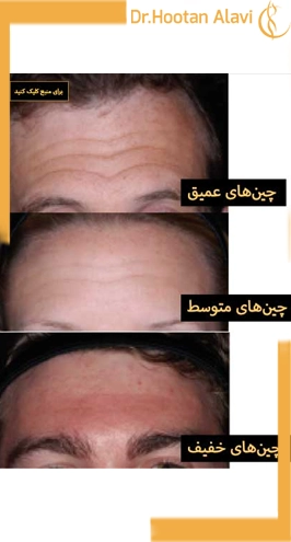 از-بین-بردن-چین‌وچروک‌های-پیشانی