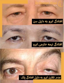 روش-های-تغییر-موقعیت-ابرو