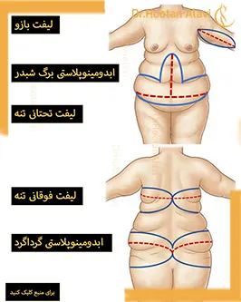 اقدامات-جراحی-زیبایی-بعد-کاهش-وزن-چه-می-باشند؟