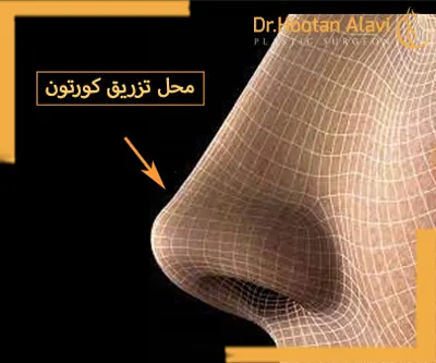محل-تزریق-کورتون-به-بینی-کجاست؟