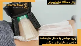 نحوه-انجام-کرایولیپولیز