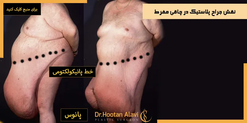 نقش-جراح-پلاستیک-در-چاقی-مفرط