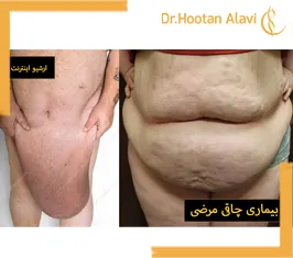 چاقی-مفرط-چیست؟