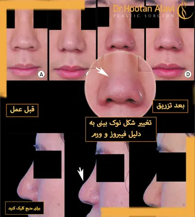 چرا-تزریق-کورتون-به-بینی-انجام-می‌شود-؟