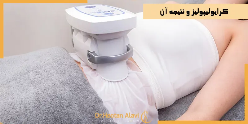 کرایولیپولیز-و-نتیجه-آن