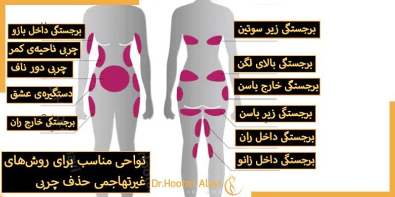 کرایولیپولیز-چیست؟