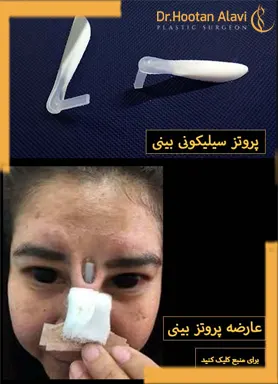 غضروف-مصنوعی