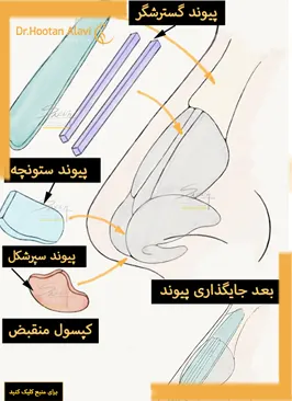 پیوند-غضروف-چه-موقع-انجام-می‌شود؟