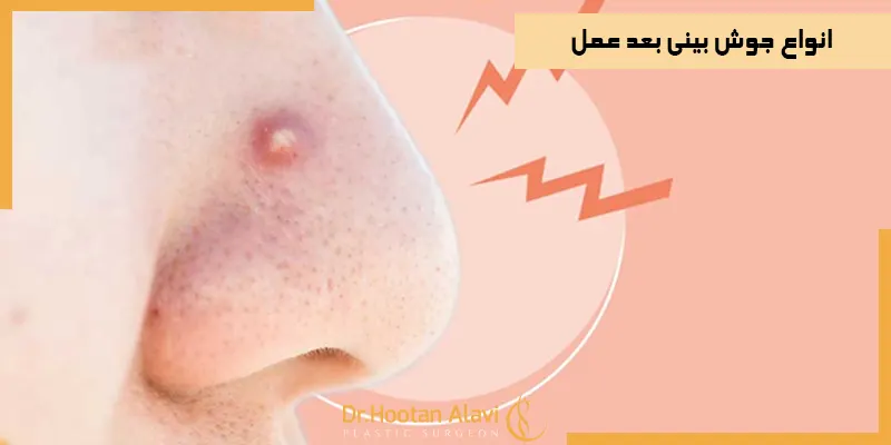 انواع-جوش-بینی-بعد-عمل