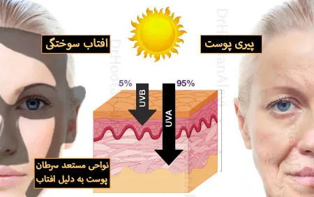 تاثیر-اشعه‌-ماوراءبنفش-بر-روی-پوست