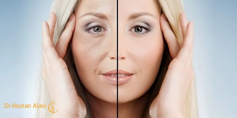 جوانسازی-صورت