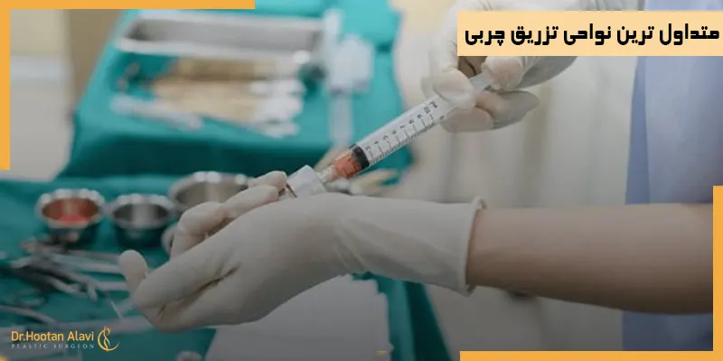 متداول-ترین-نواحی-تزریق-چربی