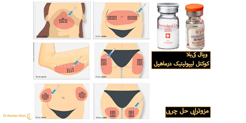 مزوتراپی-حل‌کننده‌ی-چربی