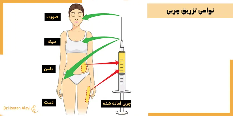 نواحی-تزریق-چربی