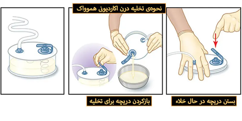 نحوه‌ی-تخلیه‌ی-درن-آکاردئونی-هموواک
